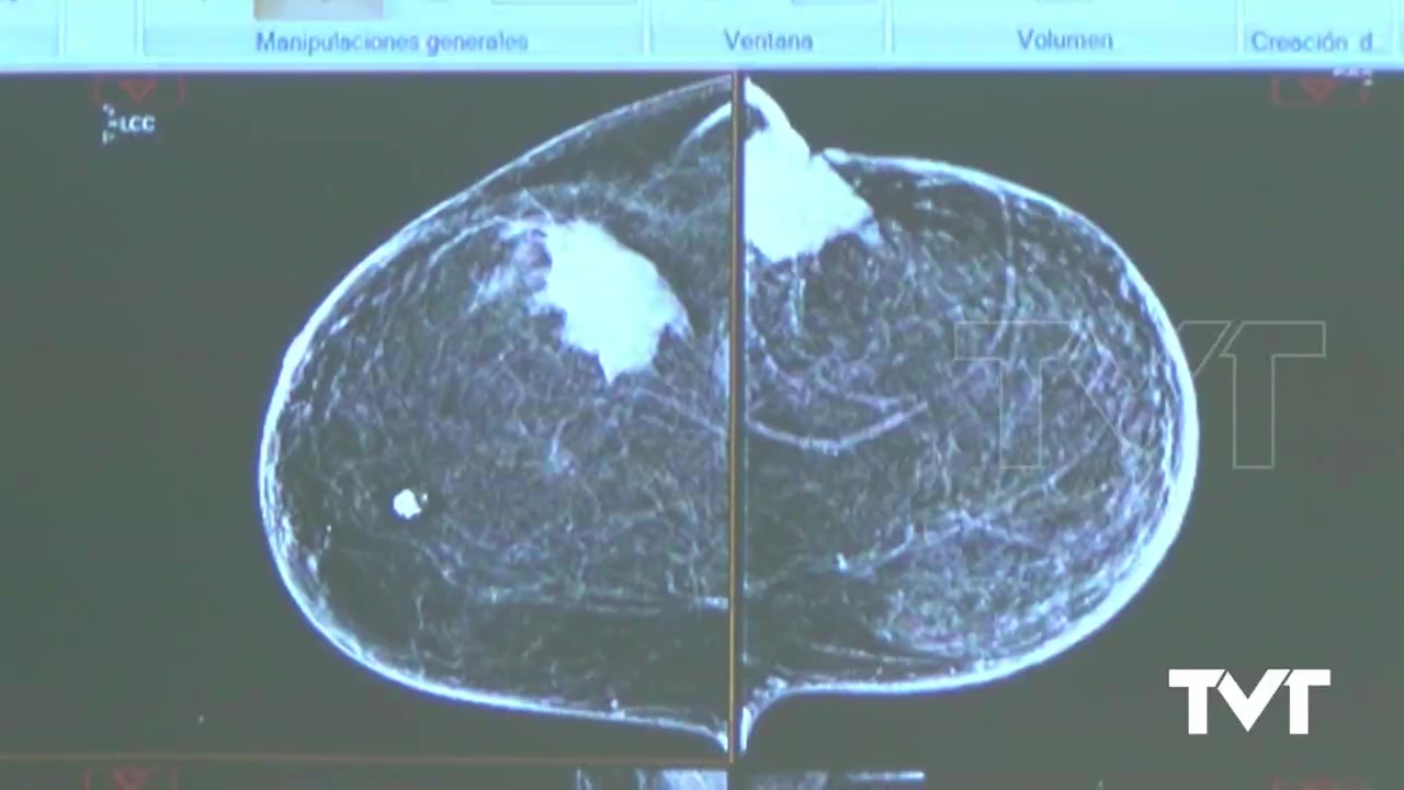 Imagen de Se reduce el tiempo de diagnóstico del cáncer de mama realizando estudios ecográficos in situ