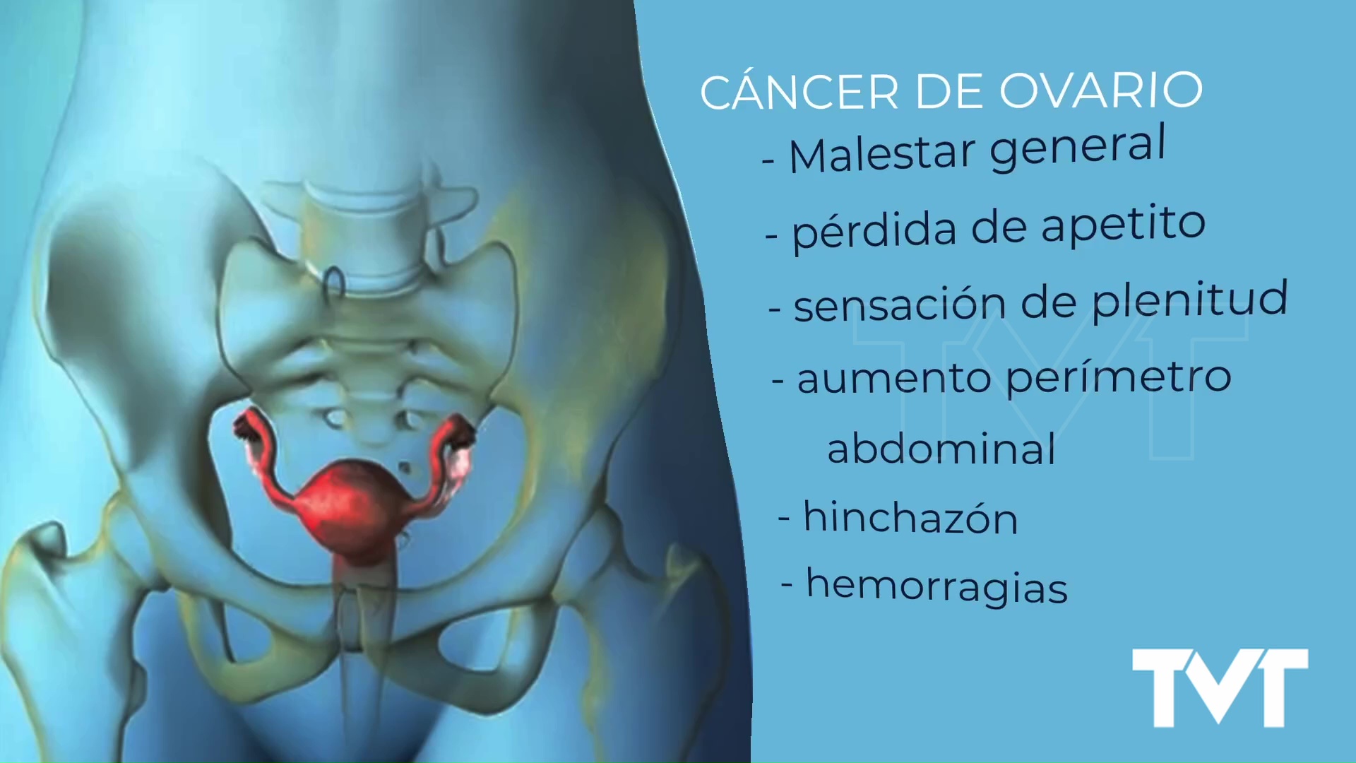 Imagen de Cáncer de ovario: una detección precoz juega un papel importante en esta enfermedad silenciosa 