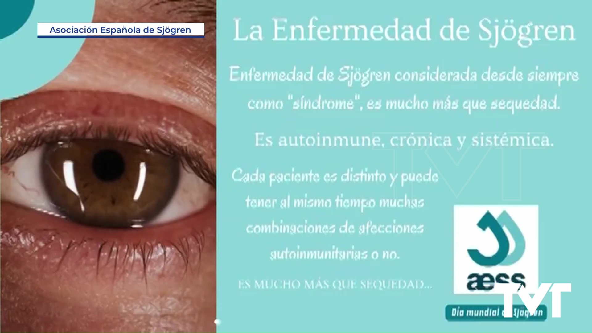 Imagen de El Hospital de Torrevieja participa en un ensayo clínica internacional sobre el Síndrome de Sjögren